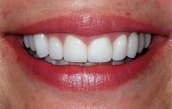 After malocclusion correction