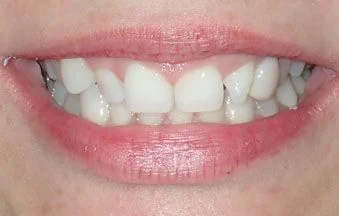 Before malocclusion correction