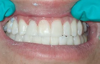 After peg lateral treatment
