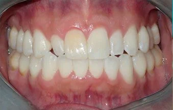 Before peg lateral treatment