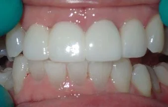 After anterior bridge treatment