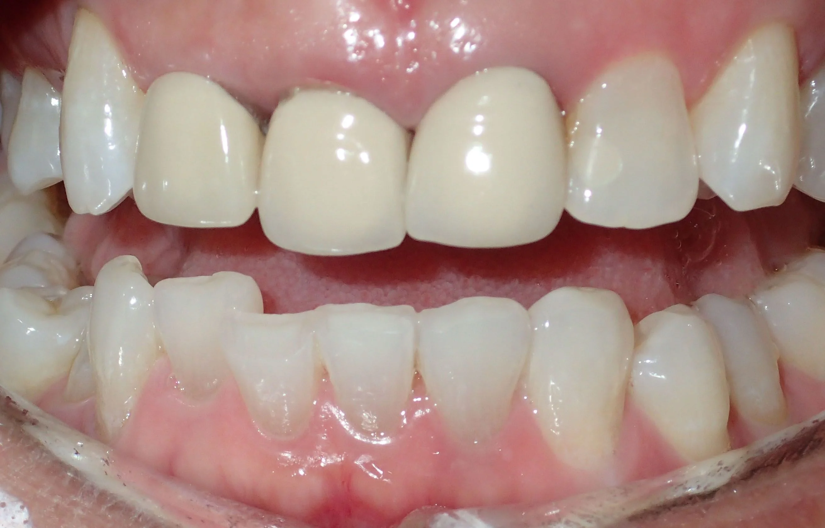 Before anterior bridge treatment