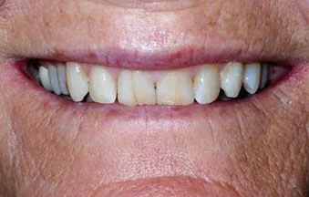 Before craze lines treatment