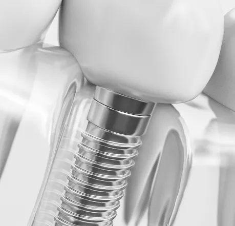 Dental Implant Restorations